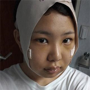 磨下頜角磨骨手術(shù)一個月了，分享一下恢復(fù)前后的果照片哇~