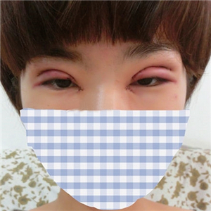 雙眼皮手術(shù)失敗修復(fù)一個月了，果不錯，有前后對比果圖片哦~