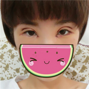 雙眼皮手術(shù)失敗修復(fù)一個月了，果不錯，有前后對比果圖片哦~