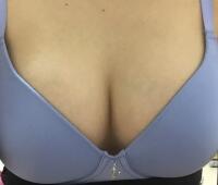 曼托假體豐胸價(jià)格恢復(fù)果圖