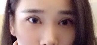 切開雙眼皮價格2680元