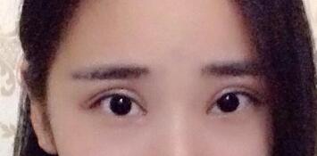 切開雙眼皮價格2680元，割雙眼皮拆線后圖片