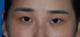 切開雙眼皮整形前圖片，價格2680元