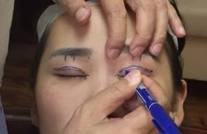 割雙眼皮術(shù)前圖片