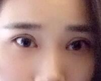 切開雙眼皮價格2680元，費用不貴果卻很好