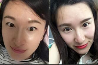 割雙眼皮前后對比圖