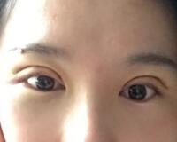 割雙眼皮過程恢復(fù)圖分享給大家，單眼皮變雙眼皮