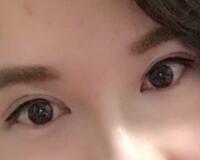 割雙眼皮過程恢復(fù)圖分享給大家，單眼皮變雙眼皮