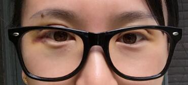 割雙眼皮恢復(fù)過程第五天