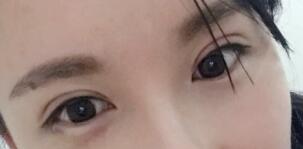 單眼皮切開為雙雙眼皮術(shù)后圖片