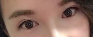 割雙眼皮過程恢復(fù)圖分享給大家,單眼皮變雙眼皮