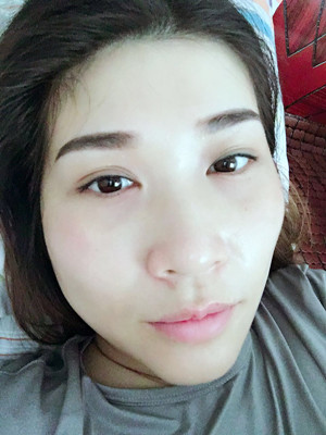 大家來評一下葛紅做的內(nèi)切去眼袋怎么樣