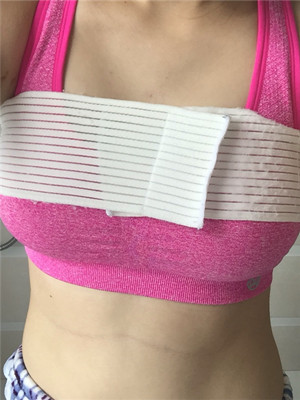 邱凌燕給我做了假體隆胸后 就挺了起來