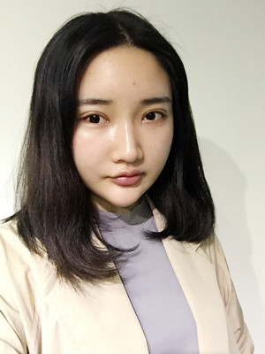 自體脂肪填充額頭以后變化很大