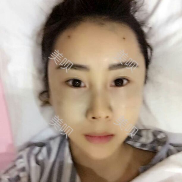 為大家分享一下韓國(guó)醫(yī)生給我做的全臉自體脂肪面部填充