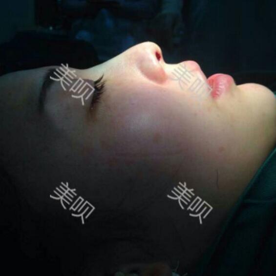 硅膠假體隆鼻后恢復(fù)得很漂亮下一步的目標(biāo)是自體脂肪全臉填充