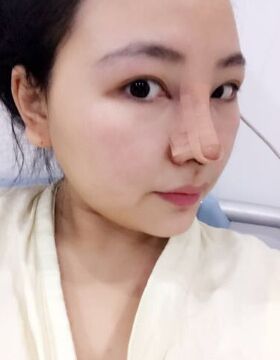 天津美萊吳勝做的硅膠假體隆鼻還墊鼻尖了