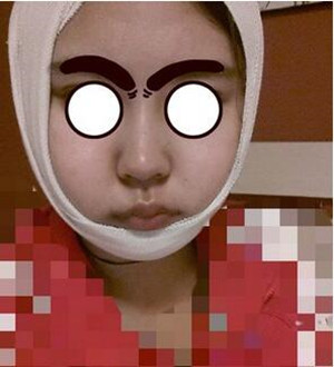 柳大烈教授幫我做磨骨瘦臉 真的很安有果也很棒