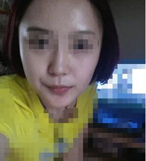 柳大烈教授幫我做磨骨瘦臉 真的很安有果也很棒