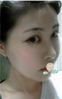 做了磨顴骨手術(shù)的我從小鴨子變成白天鵝 謝謝柳大烈教授