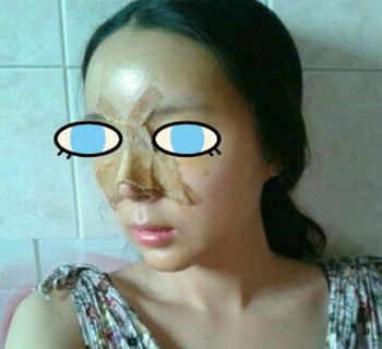 北京八大處整容醫(yī)院膨體隆鼻案例分享~