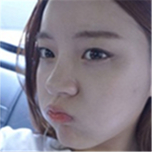 注射美白k氧注射針后一個(gè)療程的果照片，你們看前后對(duì)比，變化很大吧~