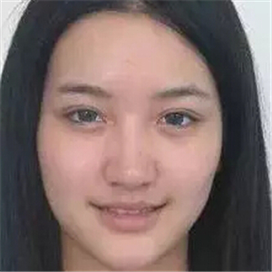 去年做的注射B****微整形，你們看看恢復(fù)前后的對(duì)比照片~~~