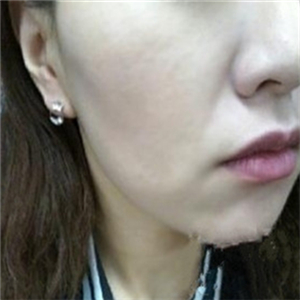 自體脂肪填充去法令紋一個(gè)星期了，分享我的恢復(fù)對(duì)比照片哦~~