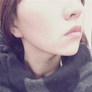 自體脂肪填充去法令紋一個(gè)星期了，分享我的恢復(fù)對(duì)比照片哦~~