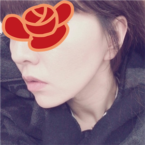 自體脂肪填充去法令紋一個(gè)星期了，分享我的恢復(fù)對(duì)比照片哦~~