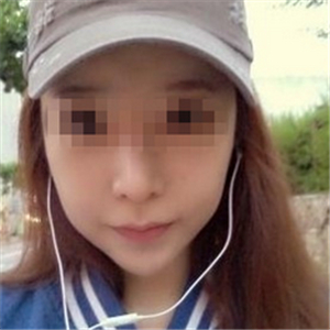 伊萊美做磨骨整形手術(shù)半年多了，分享下恢復(fù)過程照片哦~~~