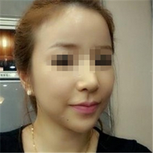 伊萊美做磨骨整形手術(shù)半年多了，分享下恢復(fù)過程照片哦~~~