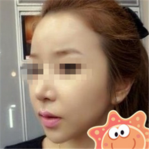 伊萊美做磨骨整形手術(shù)半年多了，分享下恢復(fù)過程照片哦~~~