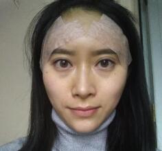 自體脂肪面部填充術(shù)后照片