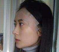 大腿吸脂做自體脂肪面部填充三個(gè)月了，分享給大家