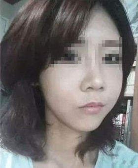 【20天康復記錄】隆鼻+面部脂肪填充，遇見更美的自己