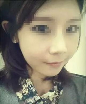 【20天康復記錄】隆鼻+面部脂肪填充，遇見更美的自己