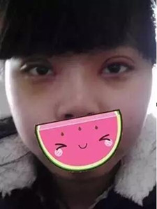 【真人案例】雙眼皮手術(shù)后，見證我的美!