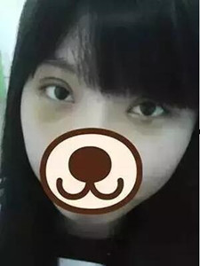 【真人案例】雙眼皮手術(shù)后，見證我的美!