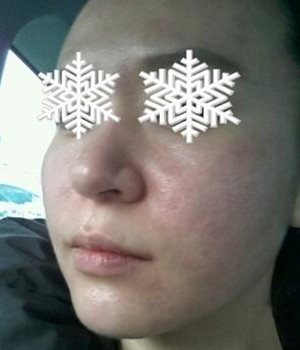 光子嫩膚后，整個人漂亮多了