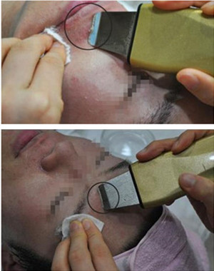 激光祛痘果怎么樣？激光祛痘前后過程對比圖