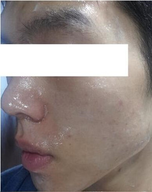 激光祛痘果怎么樣？激光祛痘前后過程對比圖