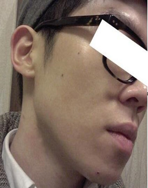 激光祛痘果怎么樣？激光祛痘前后過程對比圖