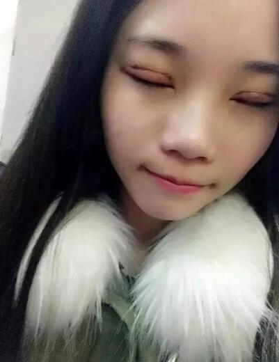 成都蜀尚蓉雅雙眼皮恢復(fù)紀(jì)實(shí) 看看果怎么樣