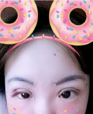 雙眼皮恢復(fù)過(guò)程分享