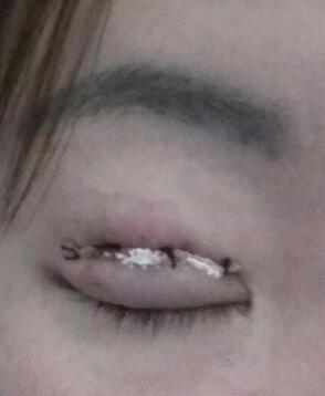 雙眼皮恢復(fù)過(guò)程分享