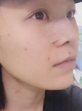 硅膠假體隆鼻給我?guī)沓每吹谋亲? /> </a>
										<a href=