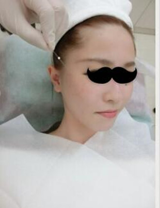 埋埋蛋白線.提升拯救了我的大小臉和皮膚下垂