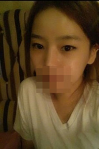 膨體隆鼻手術前后對比照片，真實案例分享！