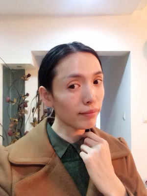 玻尿酸面部填充前后過程及對比圖片，來看看果如何